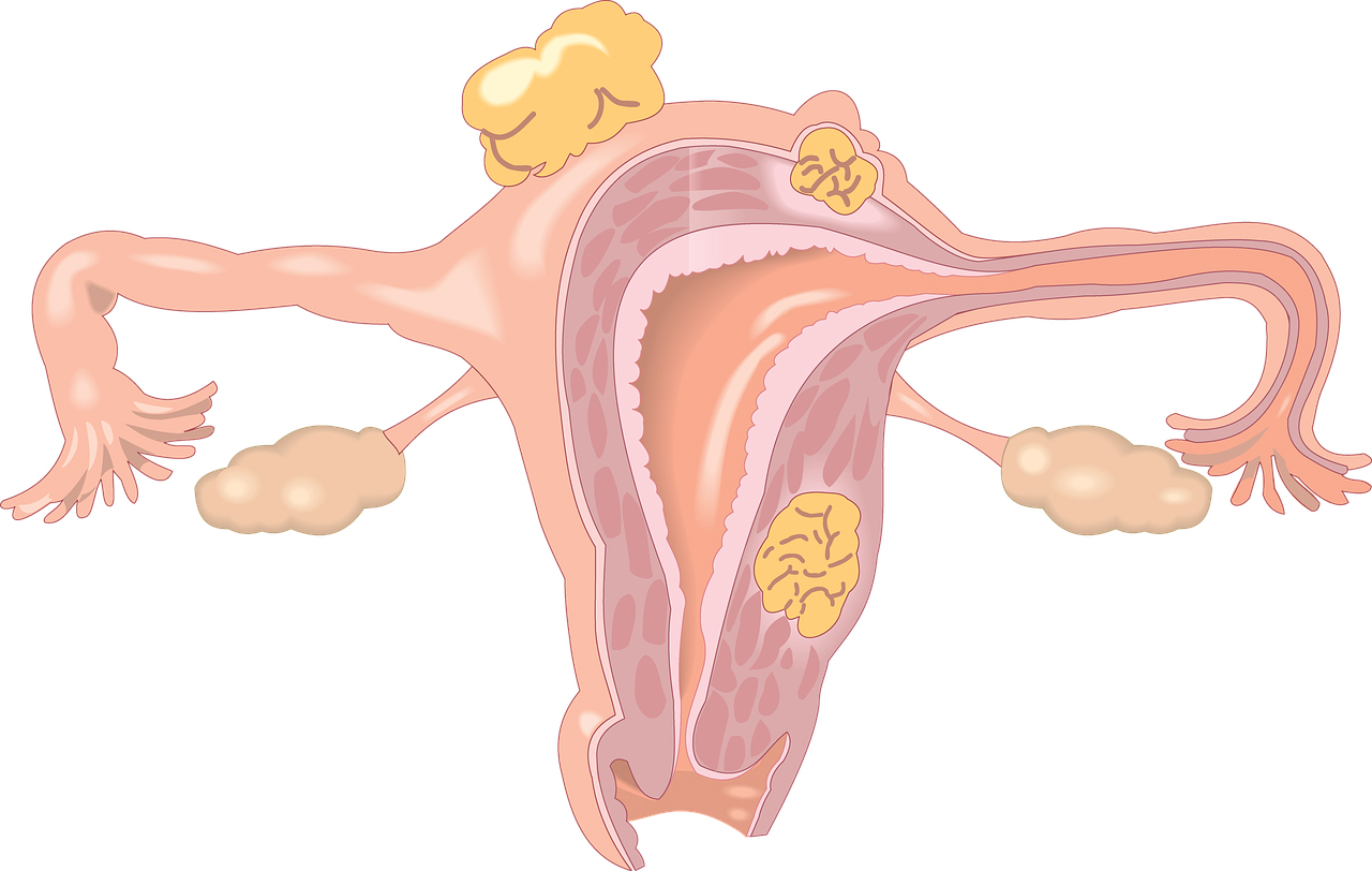 Expulsión de tejido endometrial