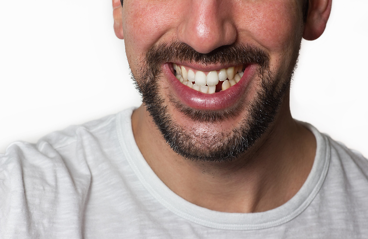 pérdida de dientes, pérdidas de dientes