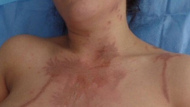 «Sentí como si me estuvieran comiendo viva»: así se vive un ataque de ácido que deja secuelas para siempre