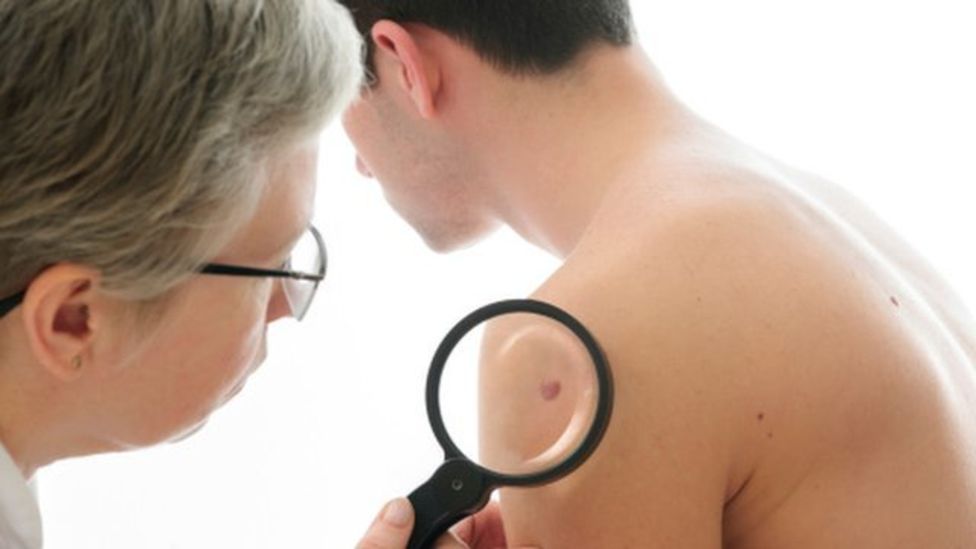 Día mundial contra el melanoma: 5 cambios en tus lunares que no debes pasar por alto