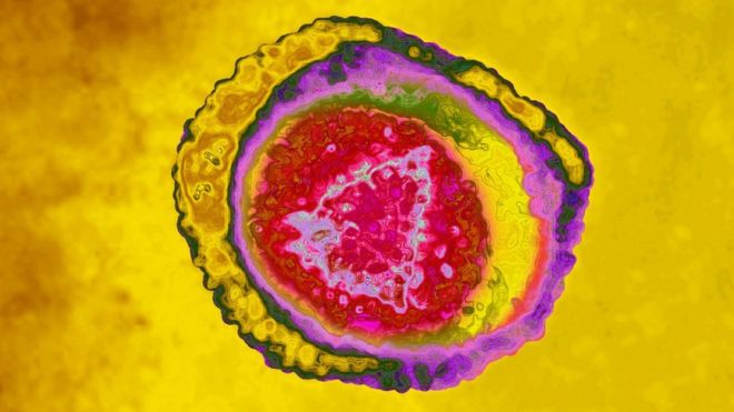 ¿Qué tiene que ver el herpes con el Alzheimer? Encuentran dos cepas del virus vinculadas con este tipo de demencia