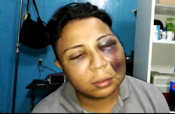 Joven relata la brutal golpiza que recibió por parte de policías en Bluefields