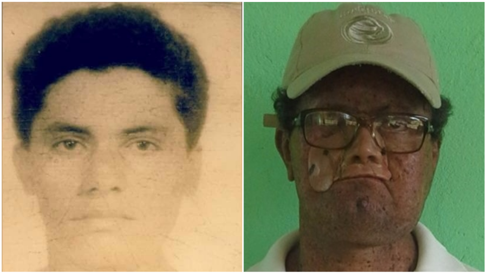 Xeroderma pigmentoso: la extraña mutación de piel que puede hacer que pierdas la nariz