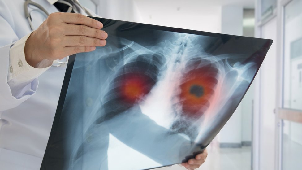 Cáncer de pulmón: el programa de Google que detecta esta enfermedad «con más eficiencia que los médicos»