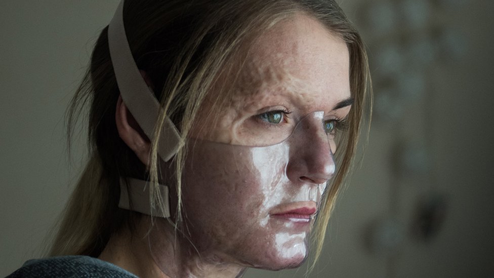 Vicky Knight, la mujer desfigurada por el fuego que se volvió actriz de cine gracias a sus cicatrices