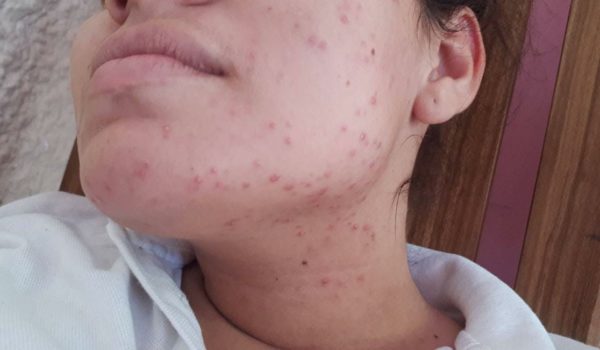 Por qué el uso de mascarillas puede producir acné y como evitar un brote
