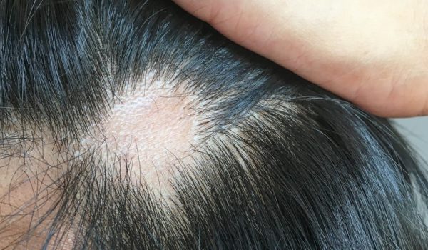 Coronavirus: qué causa y cómo tratar la caída del cabello que afecta a uno de cada cuatro infectados