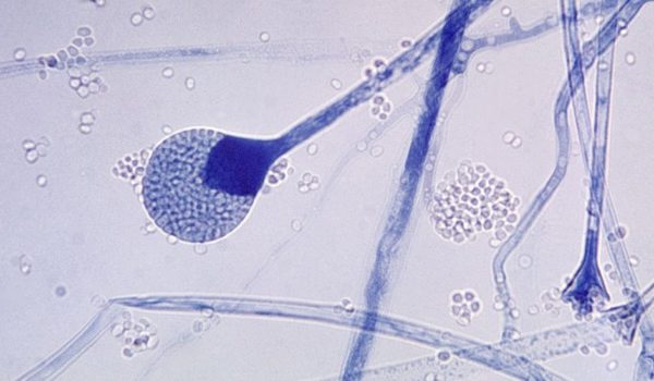 Hongo negro: 6 preguntas clave sobre la rara infección fúngica que ataca a pacientes de covid-19 en India