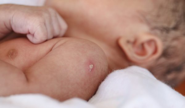 BCG: 100 años de la vacuna más antigua aún en uso (y por qué es un «dolor de cabeza» para la ciencia)