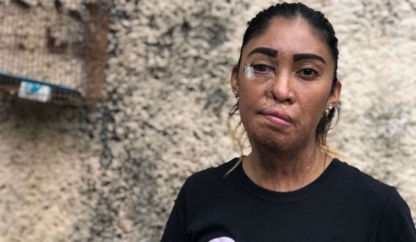 «Me decía que si yo no era suya no iba a ser de nadie. Lo dejé y me atacó con ácido»