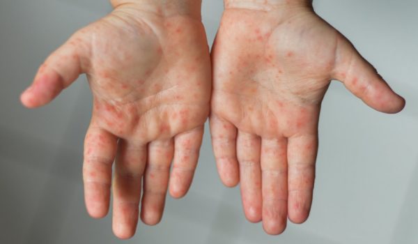 Covid: por qué están comparando a la variante ómicron del coronavirus con el sarampión