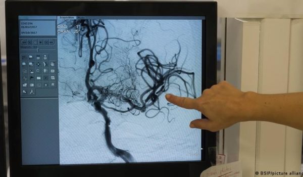 Los trombos derivados de las vacunas parecen tener solución