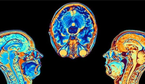 Covid: el estudio que muestra cómo cambia el cerebro tras una infección por coronavirus, aunque esta sea leve