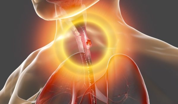 Cuáles son los síntomas del cáncer de esófago y por qué no debemos ignorarlos