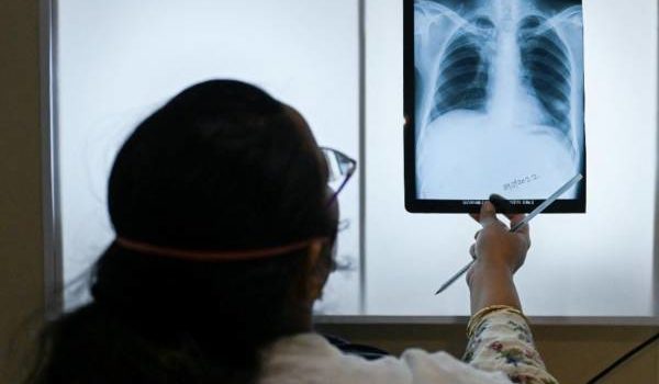 La tuberculosis vuelve a propagarse en el mundo, advierte la OMS