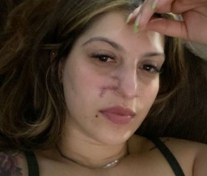 Archivo personal A Daiane Lima le dieron 27 puntos de sutura, luego de retirarle el tumor.