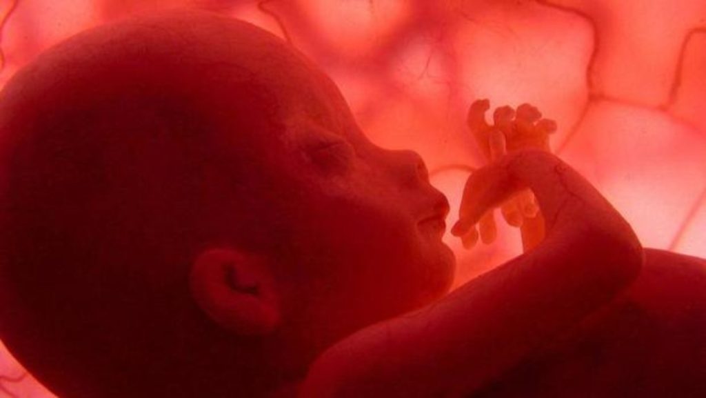 Un feto que presentaba de la vena de Galeno fue intervenido quirúrgicamente con éxito en Boston , Estados Unidos. LA PRENSA/ Tomado de Internet