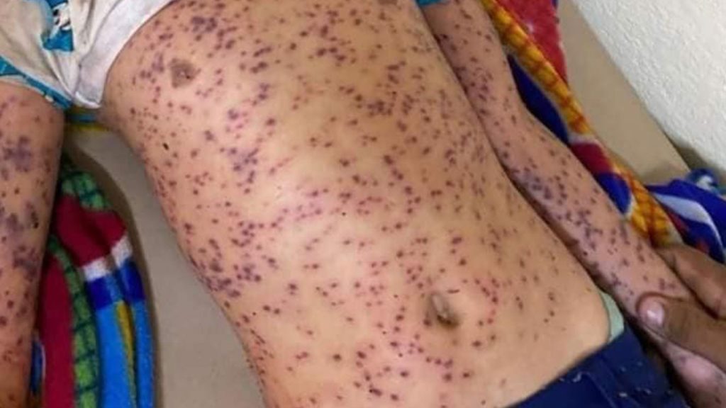 Los lesionados por la caída de una autobús en San Sebastián de Yali, departamento de Jinotega también fueron atacados por abejas africanizadas. LA PRENSA/Redes sociales