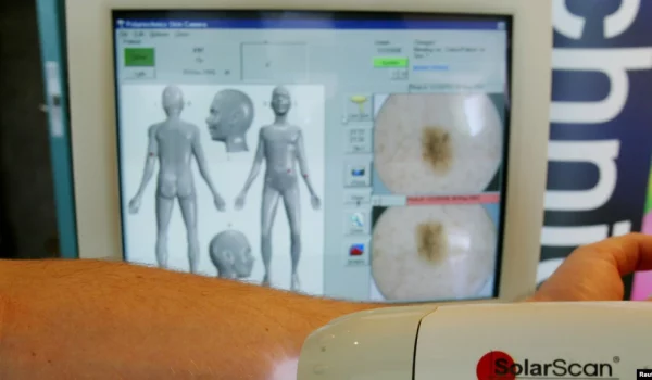Los médicos utilizan distintas herramientas para detectar cáncer de piel en los pacientes. Los expertos recomiendan hacer chequeos rutinarios y acudir a un especialista ante cualquier sospecha.