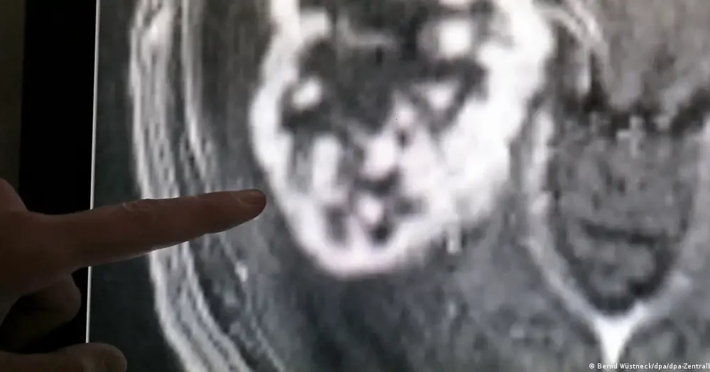 Un tumor canceroso se detecta en una imagen de resonancia magnética durante un diagnóstico.