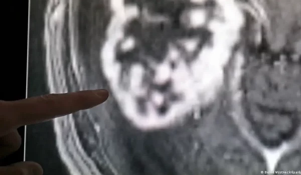 Un tumor canceroso se detecta en una imagen de resonancia magnética durante un diagnóstico.