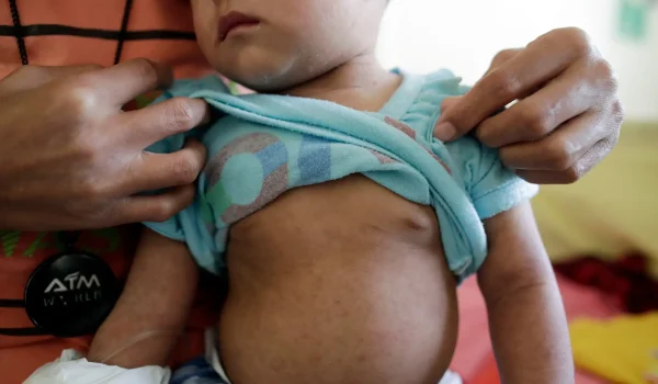 Descartan primer caso de sarampión en Nicaragua, pero se mantiene alerta sanitaria