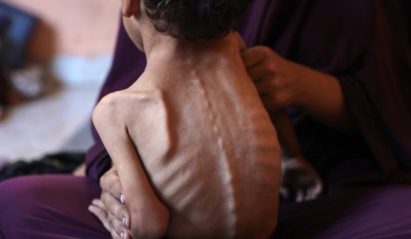 Las duras imágenes de la hambruna en Gaza