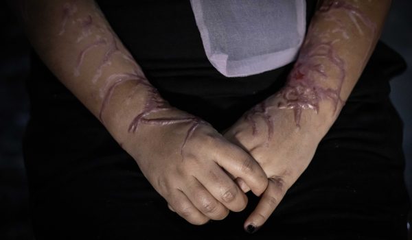 Jocelyn Vallejos, la nicaragüense que sobrevivió a un ataque con ácido de batería