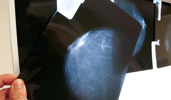 Expertos alertan sobre la falta de registros de cáncer de mama en América Latina