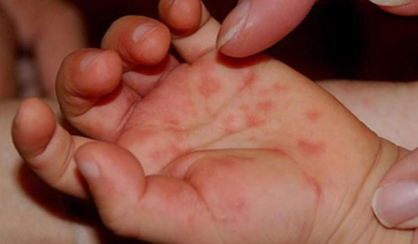 Virus Coxsackie es muy frecuente en niños y niñas. LA PRENSA