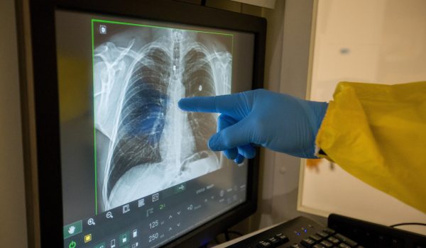 Diagnóstico temprano y prevención, pilares para mejorar salud pulmonar en América Latina