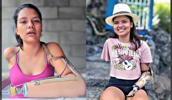 La tragedia que sufrió a los 7 años no doblegó el espíritu de Karla Castellón. LA PRENSA/ TOMADA DE REDES SOCIALES