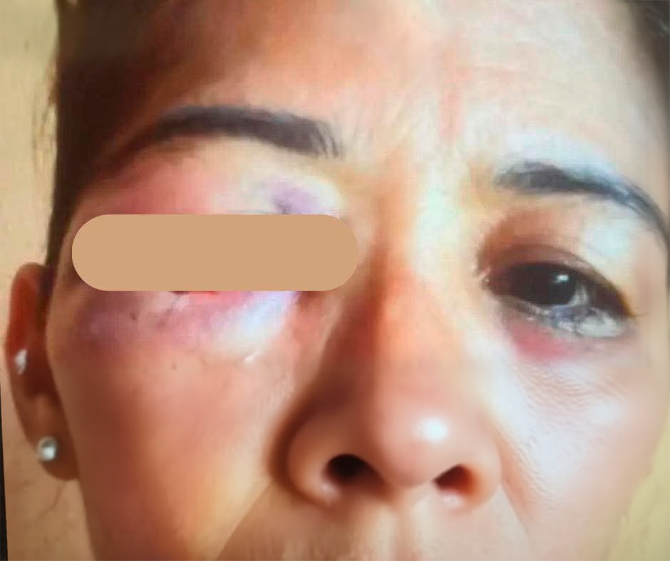 Fátima Zorayda Estrada Uriarte con lesiones en su rostro tras recibir fuerte golpiza. Foto: Miguel Mendoza/facebook.