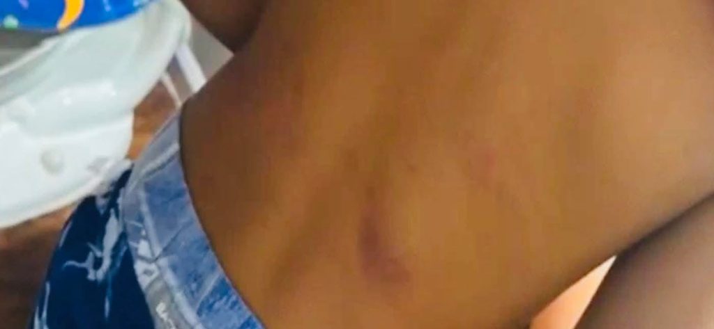 El menor presentó lesiones y moretones en todo el cuerpo, producto del maltrato del terapeuta. Foto: Captura de video/Univisión