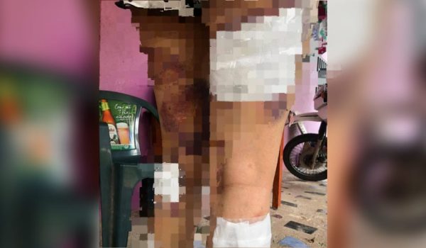 Mujer sobrevive a brutal ataque de perros pitbull en Dipilto