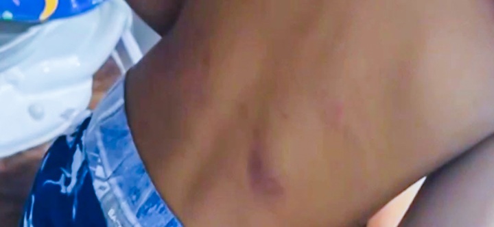 Las marcas en la espalda del niño Alexander. LA PRENSA/ REDES SOCIALES
