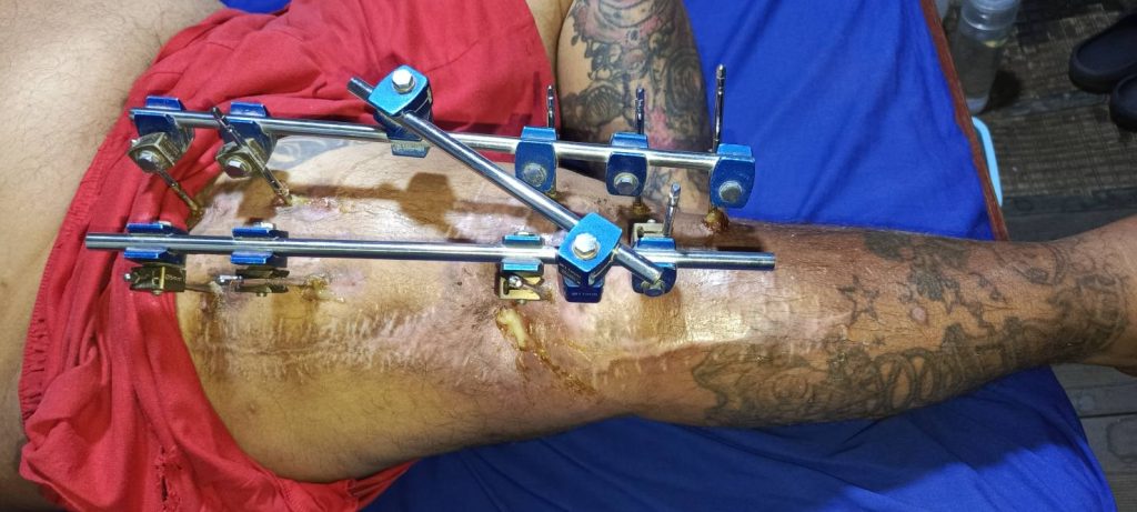 Garvin Pérez y médicos del Hospital Militar luchan por salvar su pierna