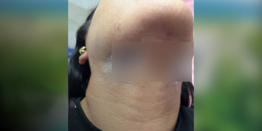 Mujer acusa a médico de malapraxis en cirugía estética. Foto: Telenica canal 8