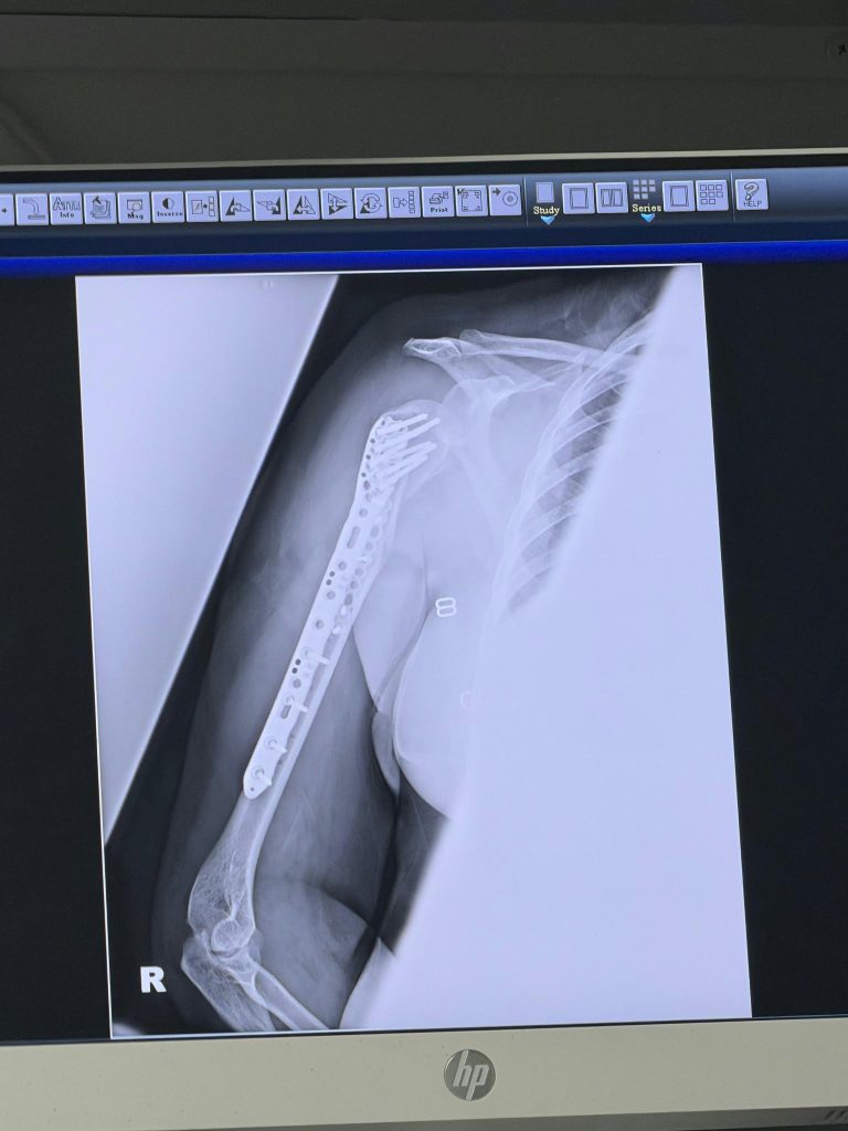 El brazo derecho de Marisol Balladares. LA PRENSA / CORTESÍA